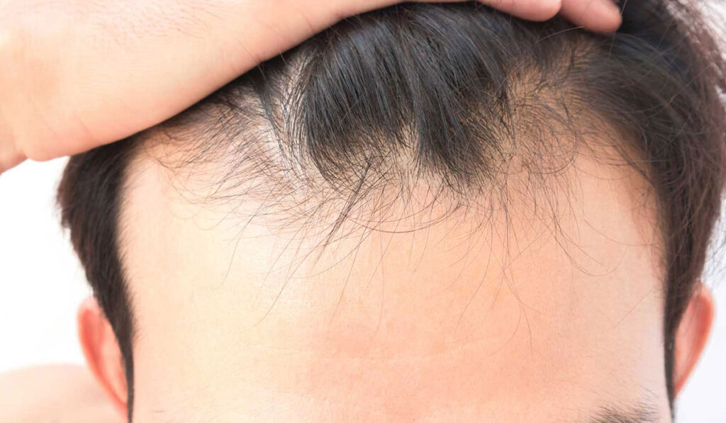 طرق علاج تساقط الشعر للرجال