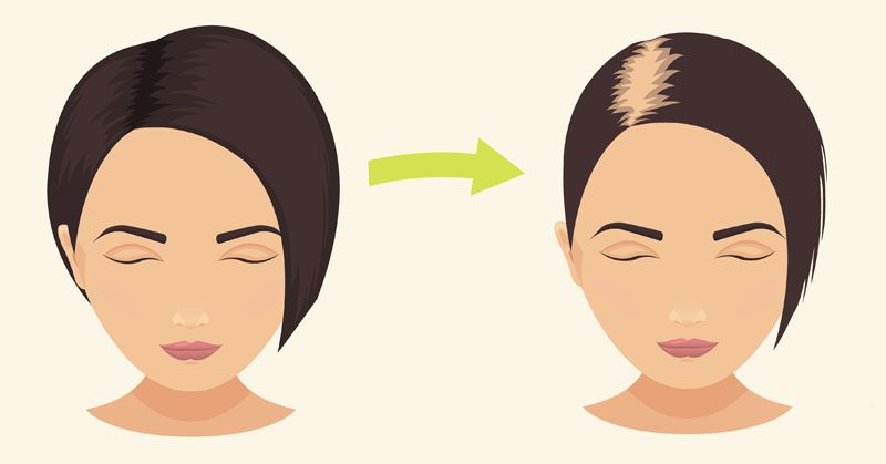 طرق علاج تساقط الشعر الشديد عند النساء